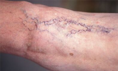 Methoden zur Behandlung von Krampfadern an den Beinen