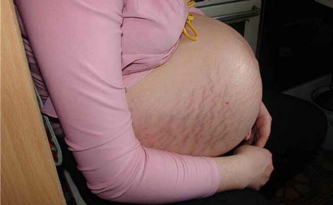 Ursachen von Krampfadern während der Schwangerschaft