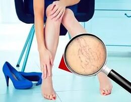 Die Symptome hängen von der Art und dem Stadium der Krampfadern ab