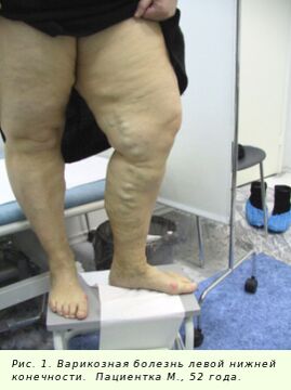 Krampfadern müssen behandelt werden, um den Prozess zu stoppen